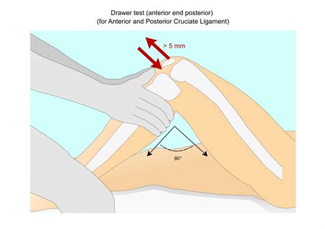 acl pcl tear test|isolated pcl tear.